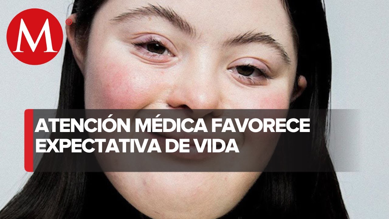 cuanto vive una persona con sindrome de down