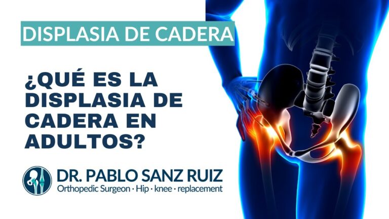 luxacion congenita de cadera en adultos