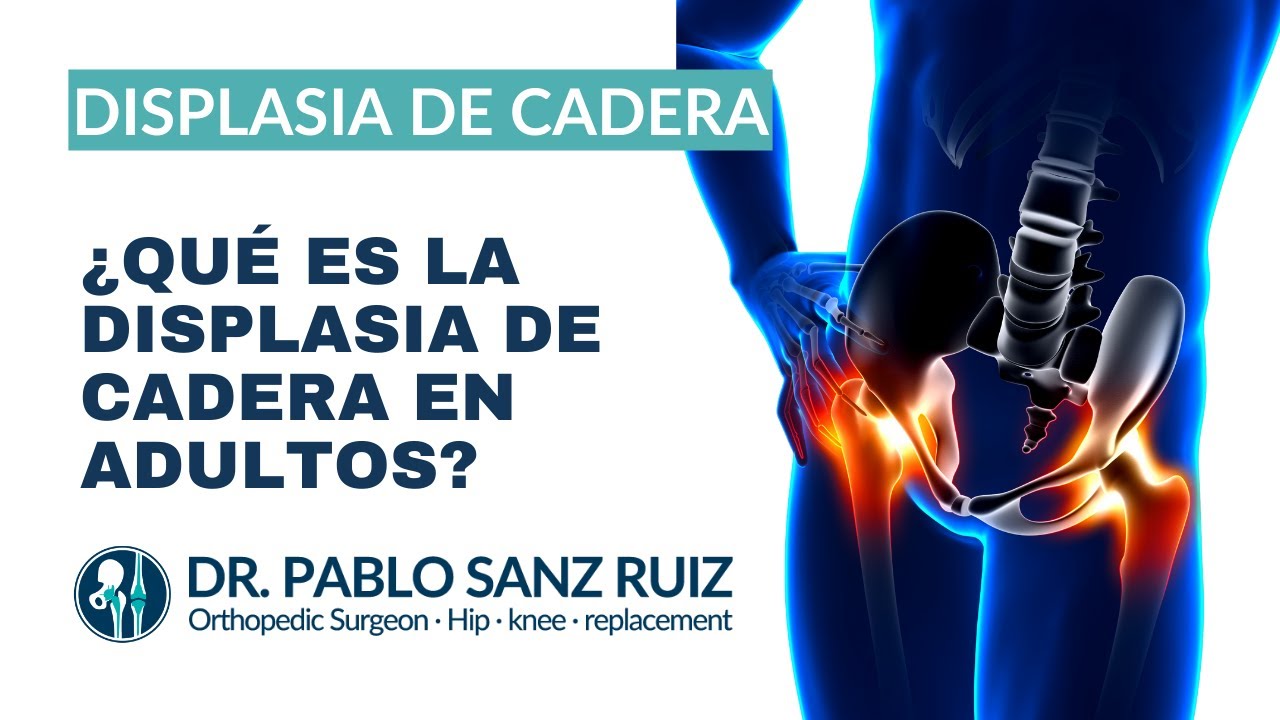 luxacion congenita de cadera en adultos